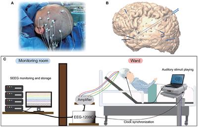 Spontaneous State Detection Using Time-Frequency and Time-Domain Features Extracted From Stereo-Electroencephalography Traces